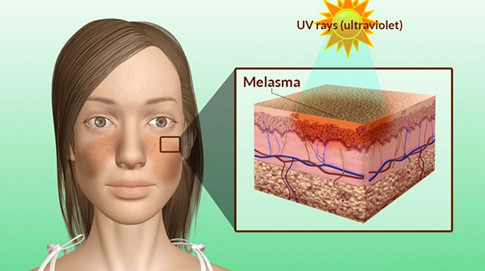 Nám da là biểu hiện của tình trạng gia tăng quá mức hắc sắc tố melanin dưới da
